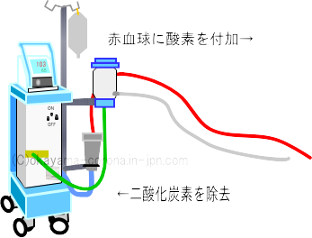 体外式膜型人工肺(ECMO)のイメージ図